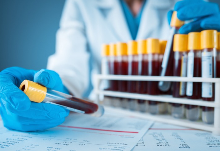 Laborergebnis Reagenzglaeser mit Blut